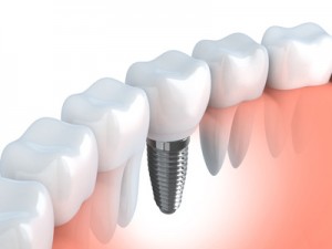 Tooth human implant (done in 3d graphics)