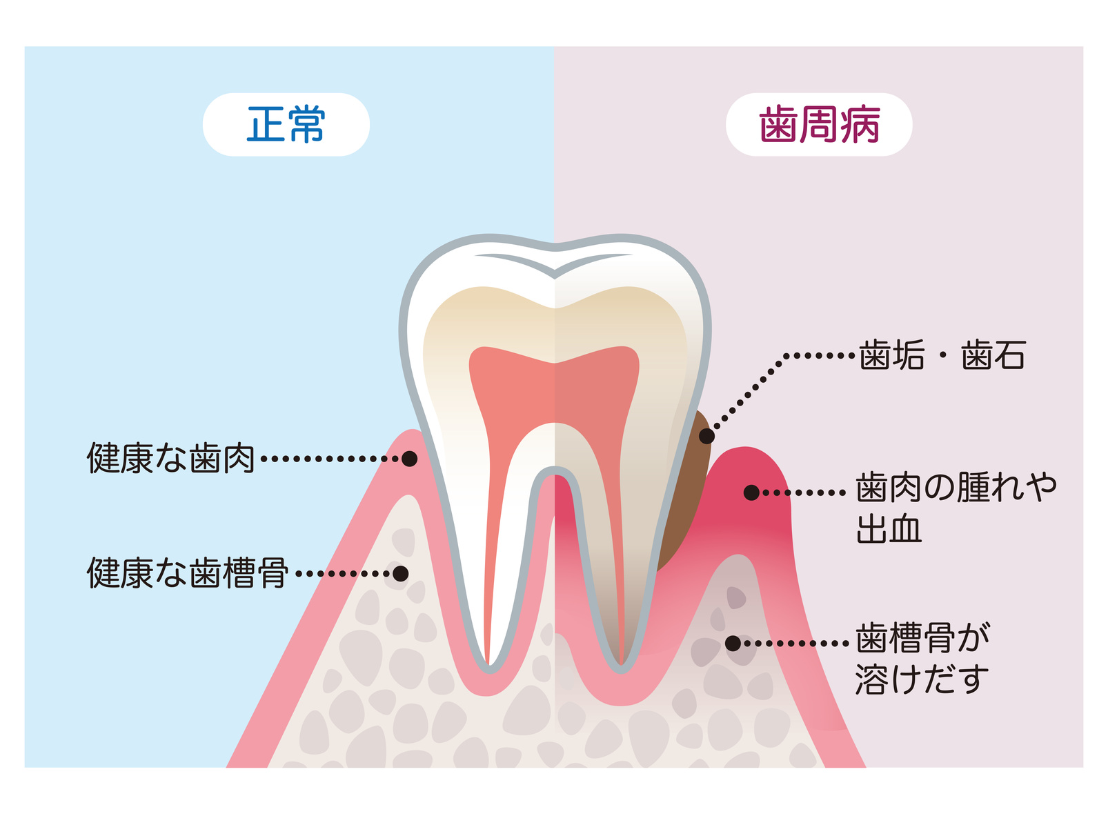 川上歯科パンジョ診療所 歯周病とそれに伴う症状の関係